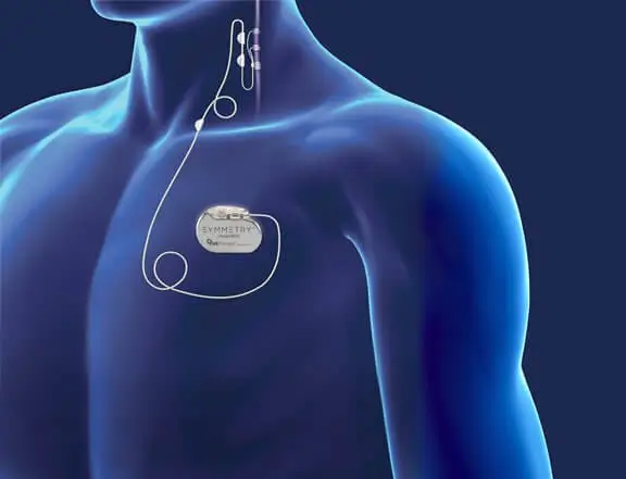 Body showing placement of VNS Therapy device and lead