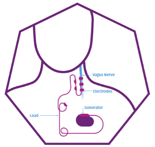 VNS surgery implant placement diagram