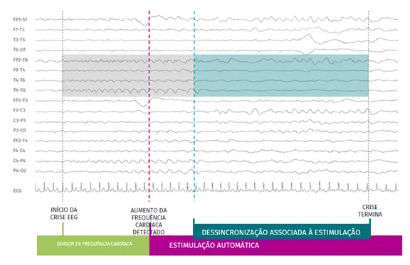 SenTiva™ detects and responds to rapid increases in heart rate that may be associated with a seizure