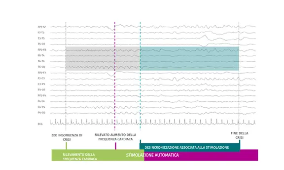 SenTiva™ detects and responds to rapid increases in heart rate that may be associated with a seizure