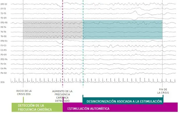 SenTiva™ con AutoStim detecta y responde a los aumentos rápidos de la frecuencia cardíaca que pueden estar asociados a una crisis