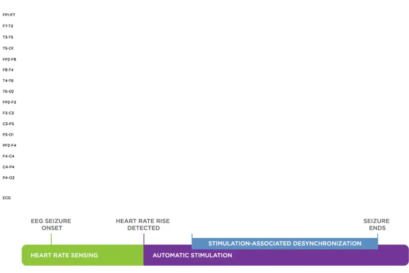 AspireSR™ detects and responds to rapid increases in heart rate that may be associated with a seizure