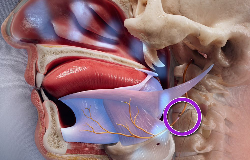 The pHGNS cuff attaches to the proximal hypoglossal nerve.