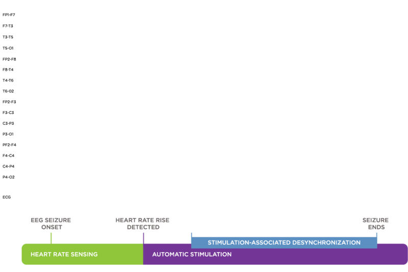 AspireSR™ detects and responds to rapid increases in heart rate that may be associated with a seizure