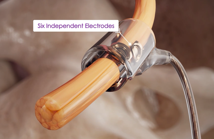 pHGNS uses six electrodes that access all major airway muscle groups.
