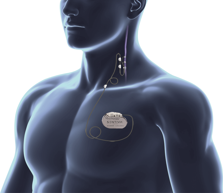 SenTiva™ VNS Therapy