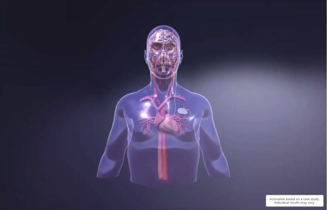 成人のDRE治療 - VNS Therapy Epilepsy | LivaNova 日本