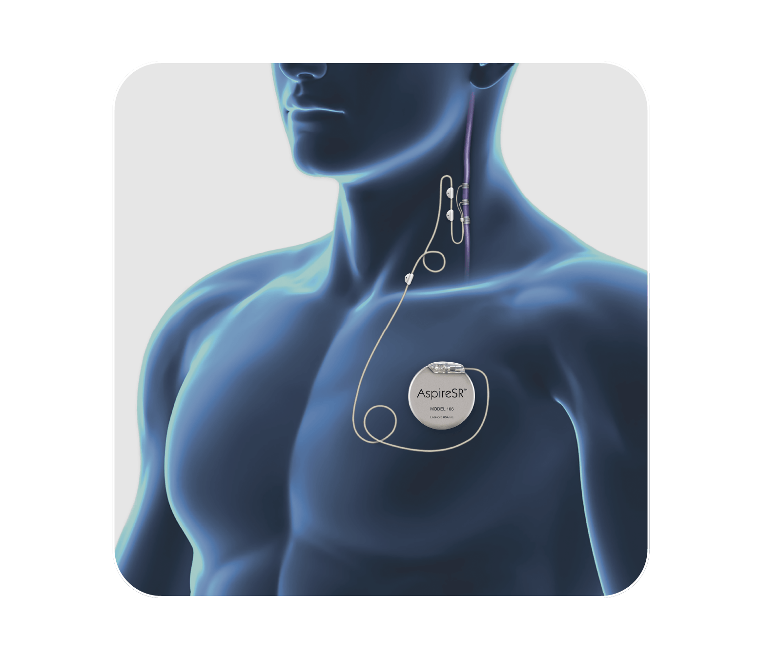 AspireSR™ VNS Therapy device