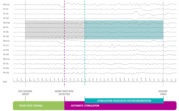 SenTiva™ detects and responds to rapid increases in heart rate that may be associated with a seizure